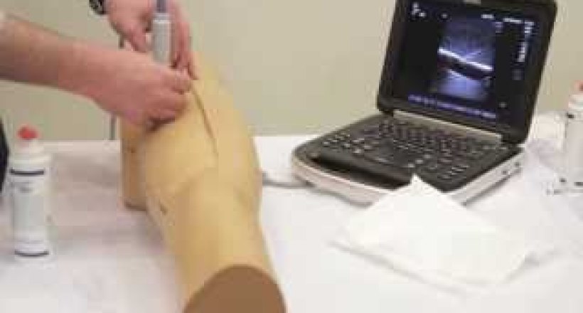 Ultrasound Guided Femoral Arterial Access